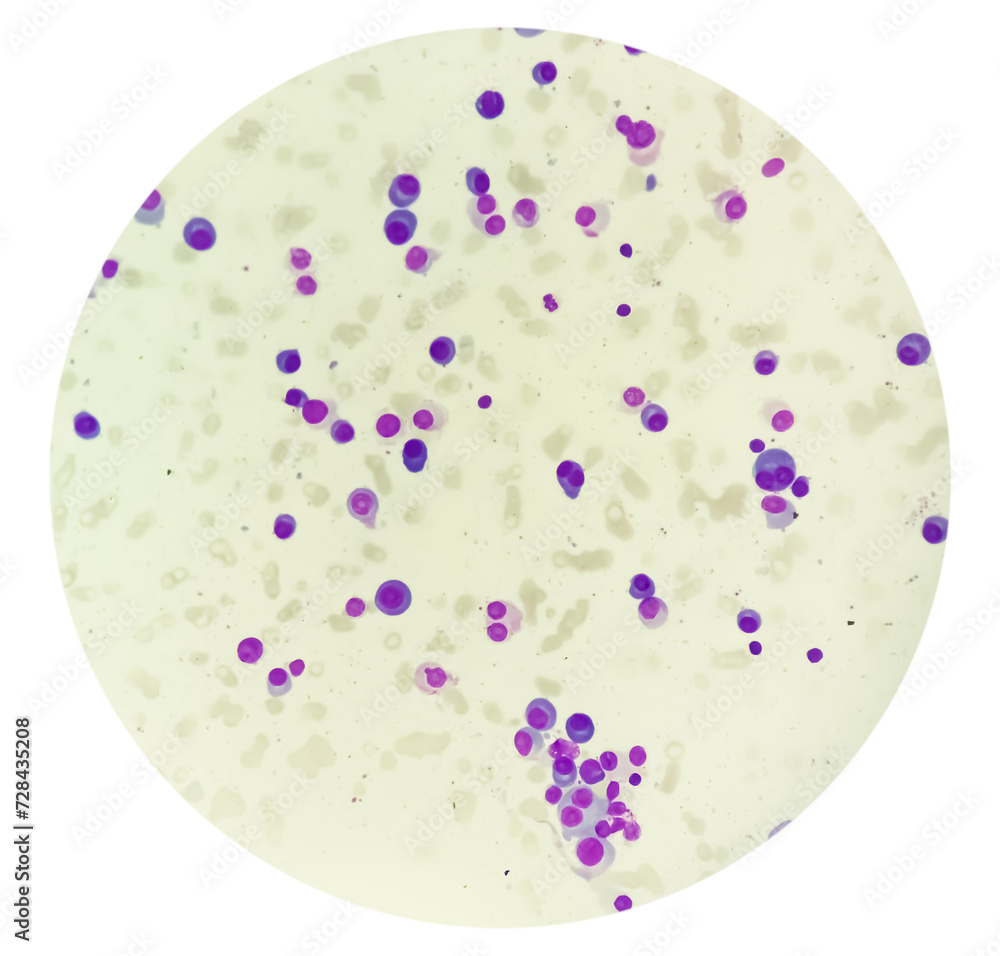 Poster Microscopic view of bone marrow slide showing Multiple myeloma, a type of bone marrow cancer.