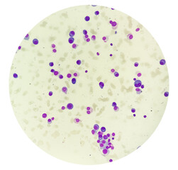 Microscopic view of bone marrow slide showing Multiple myeloma, a type of bone marrow cancer.