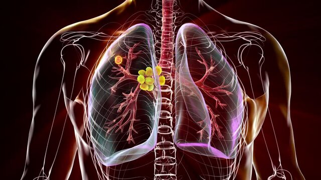 Primary lung tuberculosis, 3D animation featuring the Ghon complex and mediastinal lymphadenitis.