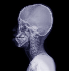 X-ray view of the lateral c-spine and lateral skull.