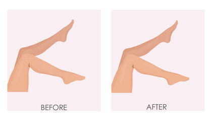 Vector illustration of before-after transformation. Hair removal on legs and shins. Laser hair removal, electrolysis or sugaring.
