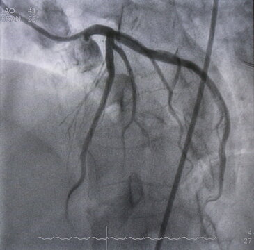 Coronary angiogram (CAG) was performed normal left coronary artery (LCA).