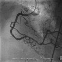 Coronary angiogram (CAG) was performed right coronary artery (RCA) stenosis.