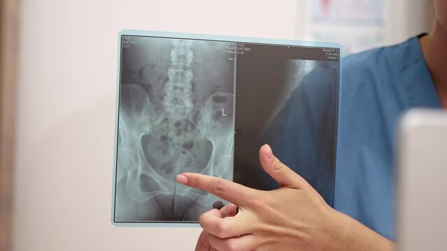 close up doctor hand pointing finger on x-ray film showing to patient in laptop during online tele medicine consultation