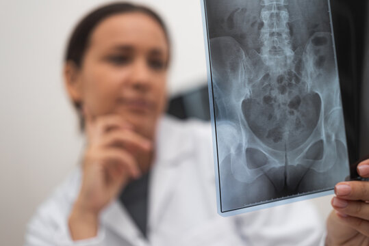 Pensive doctor analyzes X-ray picture of patient pelvis young female practitioner makes diagnosis working in modern hospital closeup on blurred background