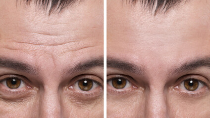 Aging skin changes. Man showing face before and after rejuvenation, closeup. Collage comparing skin...