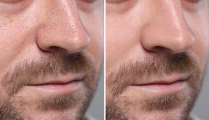 Blackhead treatment, before and after. Collage with photos of man on grey background, closeup view