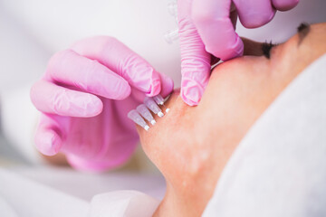 A woman undergoes a thread lifting procedure to correct her facial skin - skin tightening