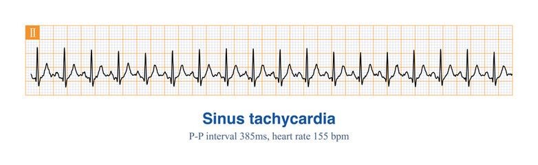 The frequency of sinus impulses exceeds 100 beats per minute, and the electrocardiogram diagnosis is sinus tachycardia. The important differential diagnosis is atrial tachycardia.