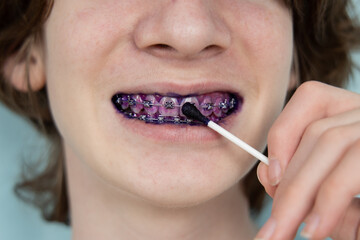 Plaque indicator on human teeth with braces. Plaque is colored pink. Teenager using plaque indicator gel. Teeth care.