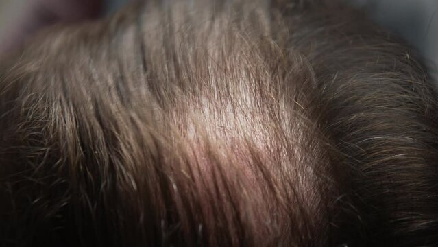 Close-up top view of balding male head, brunette man with hair loss problem combs his head with black comb