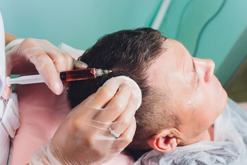 Treatment of baldness with beauty injections. Cosmetologist hands in gloves make a subcutaneous...