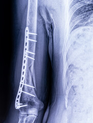 X-ray image osteosynthesis of a humerus fracture