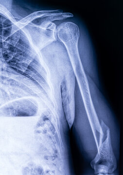 X-ray of a displaced humerus fracture