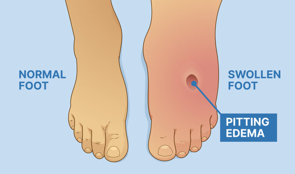 Normal foot, swollen foot. Before, after. Pitting edema.  Vector illustration. 