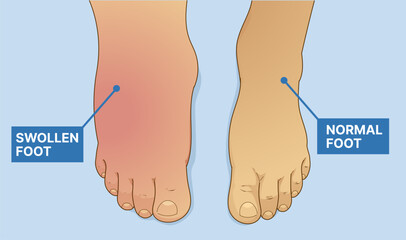 Swollen foot, normal foot. Before, after. Healthcare illustration. Vector illustration. 