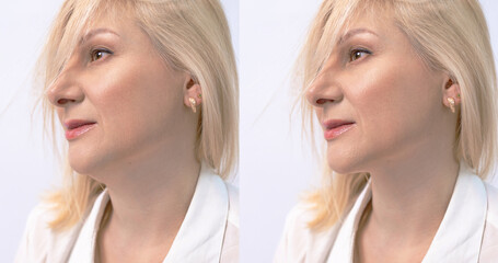 Female double chin before and after correction. Correction of the chin shape liposuction of the...