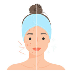 Сartoon woman with acne problem compare with woman with normal skin. Skin care procedure concept person. Vector design illustrations.