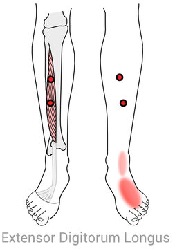 Extensor digitorum longus myofascial trigger points and associated pain locations