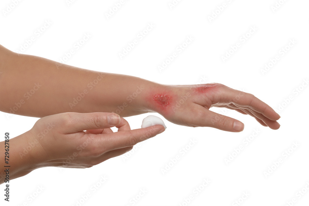 Wall mural Woman applying panthenol onto burned hand on white background, closeup