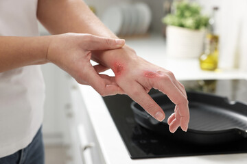 Woman with burns on her hand in kitchen, closeup