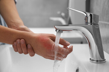 Woman holding burned hand under cold water indoors, closeup
