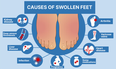 Causes of swollen feet. Healthcare infographic, educational illustration. Vector illustration.  - obrazy, fototapety, plakaty