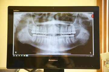 Panoramic Dental X-ray on Monitor in Clinic