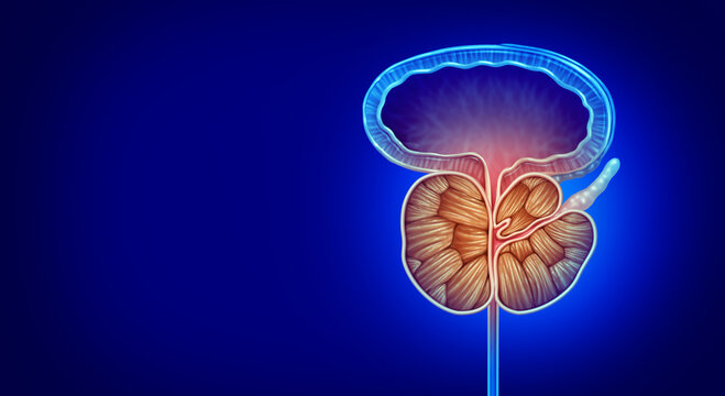 Prostate That Is Enlarged as a human gland as Benign Prostatic Hyperplasia as a urology medical illustration concept for part of the male reproductive anatomy and lower urinary tract symptoms.