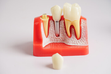 Dental implant, artificial tooth roots into jaw, root canal of dental treatment, gum disease, teeth model for dentist studying about dentistry.