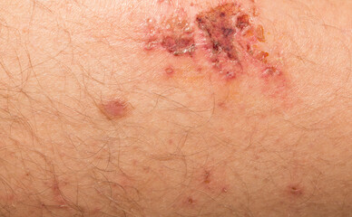 A wound on the body. Skin regeneration. Limb injury.