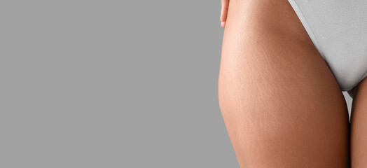 Beautiful young woman with stretch marks on her body against grey background with space for text, closeup