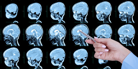 Doctor's hand points to a set of MRI scans of the human skull and brain, with cerebral...