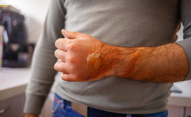 A man's hand burned with boiling water. On it there are redness and blisters.