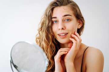 Portrait of a beautiful woman without makeup with imperfect skin. Acne skin. Natural beauty....