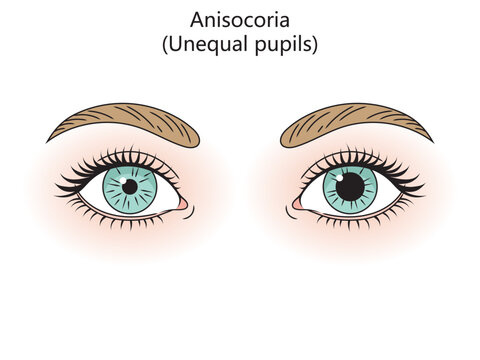 Human eyes with anisocoria diagram hand drawn schematic vector illustration. Medical science educational illustration