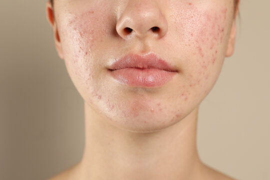 Teenage girl with acne problem on beige background, closeup