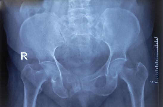 X-ray image of female pelvic. Scleroses are noted at the articular margins of both SI joints.