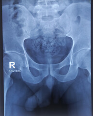 X-Ray film of RGU and MCU (Retrograde urethrogram and micturating cystogram). Radiological test...