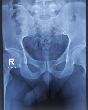 X-Ray film of RGU and MCU (Retrograde urethrogram and micturating cystogram). Radiological test that inject dye via  urethra to identify urethral narrowing. Narrow stream of urine with significant PVR