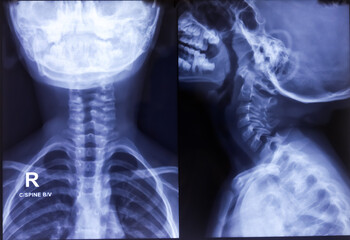 Cervical spine x-ray showing normal radiography.