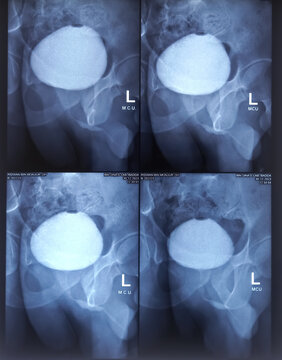 X-Ray film of RGU and MCU (Retrograde urethrogram and micturating cystogram). Radiological test that inject dye via  urethra to identify urethral narrowing. Narrow stream of urine with significant PVR