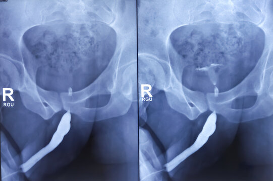 X-Ray film of RGU and MCU (Retrograde urethrogram and micturating cystogram). Radiological test that inject dye via  urethra to identify urethral narrowing. Narrow stream of urine with significant PVR