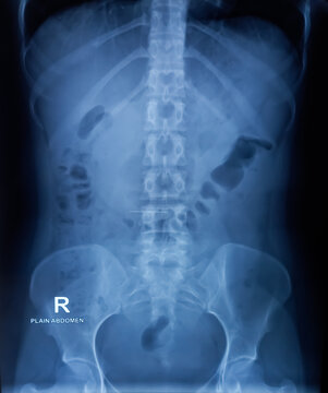 Plain X-ray of Abdomen in erect posture. Large bowel loops are distended with gas and loaded faecal matters. Linear radio opaque shadow suggest matallic foreign body at abdomenal region.