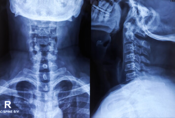 X-ray of Cervical spine AP and Lateral view. Early degenerative change at cervical spine. Minimal marginal osteophytes are noted in the cervical vertebrae.