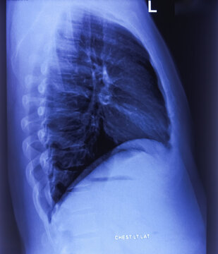 CXR PA view. Chest X-ray rediograph. Lateral view. Normal findings.