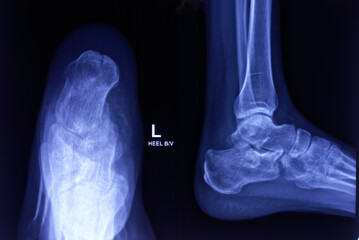 X-ray image of broken calcaneus(heel), both view. Old fracture is noted at left calcaneum.