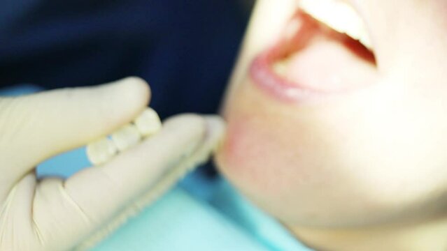 Dentist hand in gloves holds dental bridge before woman treatment in clinic, close up
