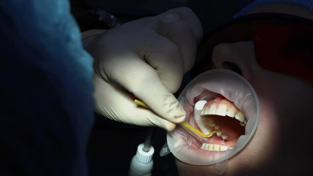 Stomatologist covers tooth by yellow glue during preparation for dental operation