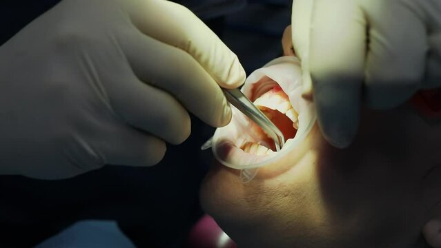 Dentist inserts tampon in patient mouth with lips holder. Slow motion